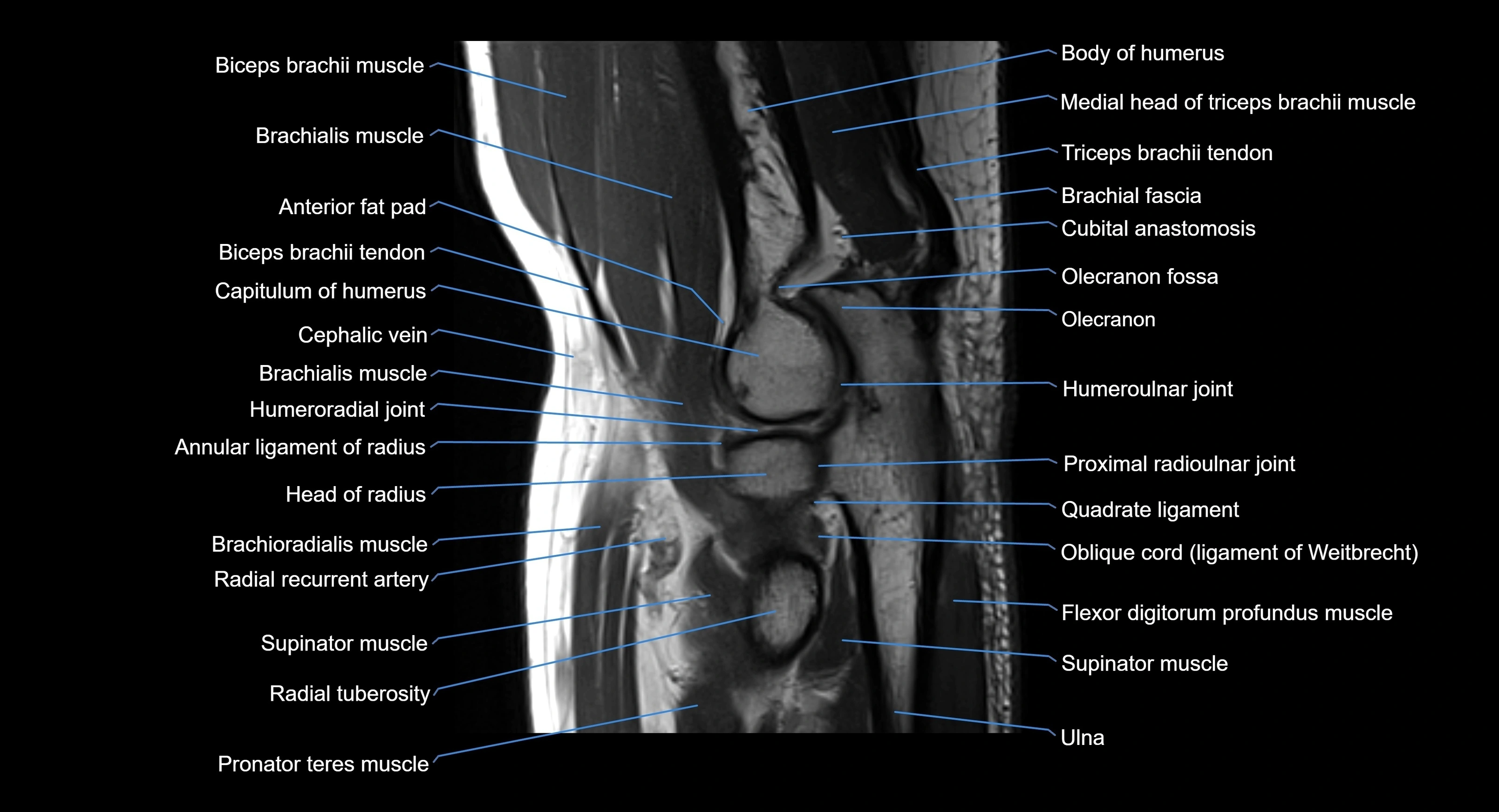MRI elbow joint  sagittal cross sectional anatomy 3T  radiology  image-img-00001-00015.webp